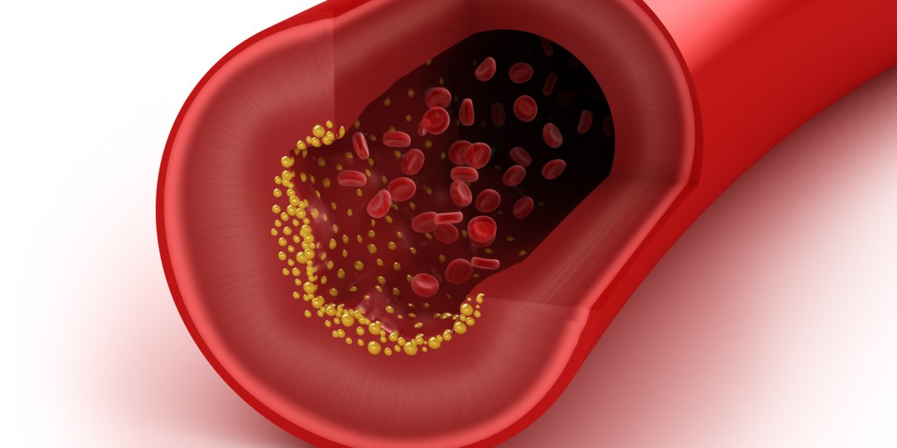 Cholesterol plaque in artery