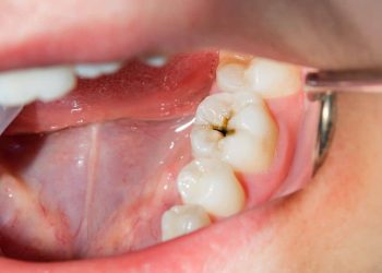 Rotten tooth.