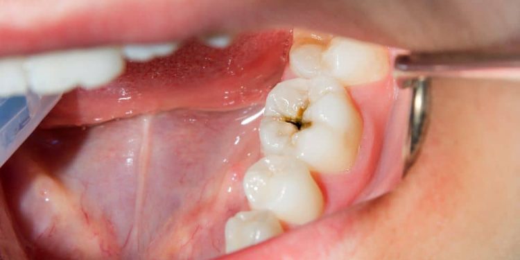 Rotten tooth.