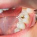 Rotten tooth.
